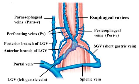 esophageal varices definition